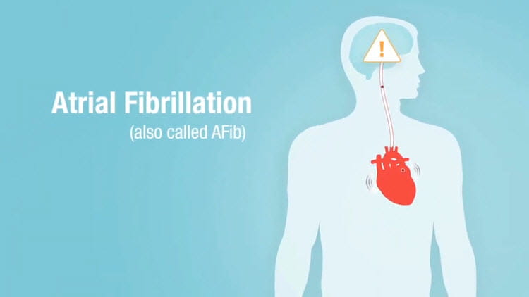 Signs and Symptoms of Atrial Fibrillation